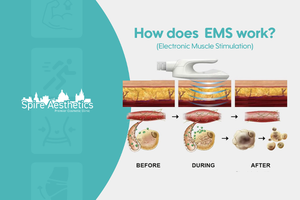 EMS treatment for post pregnancy weight loss treatment Margate