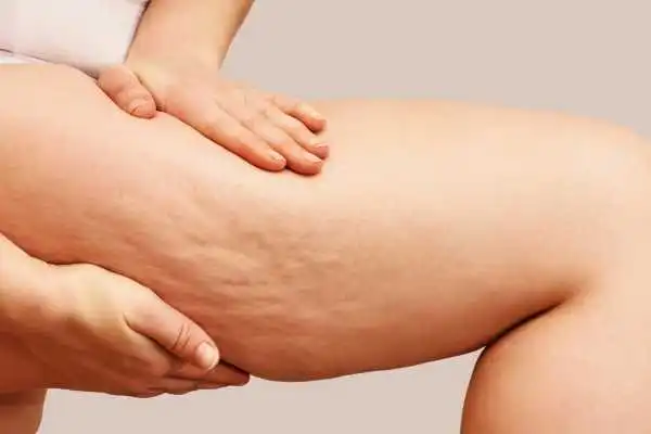 Image of woman showing leg with cellulite Margate