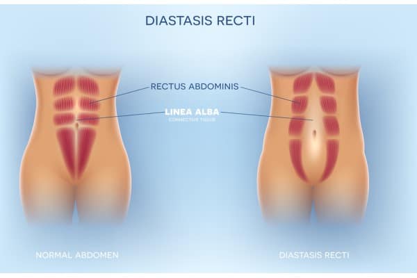 What Non-Surgical Options Are Available for Diastasis Recti Margate?