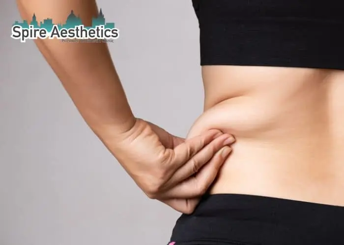 Image of woman pinching fat on their hips Margate. Fat Freezing treatment