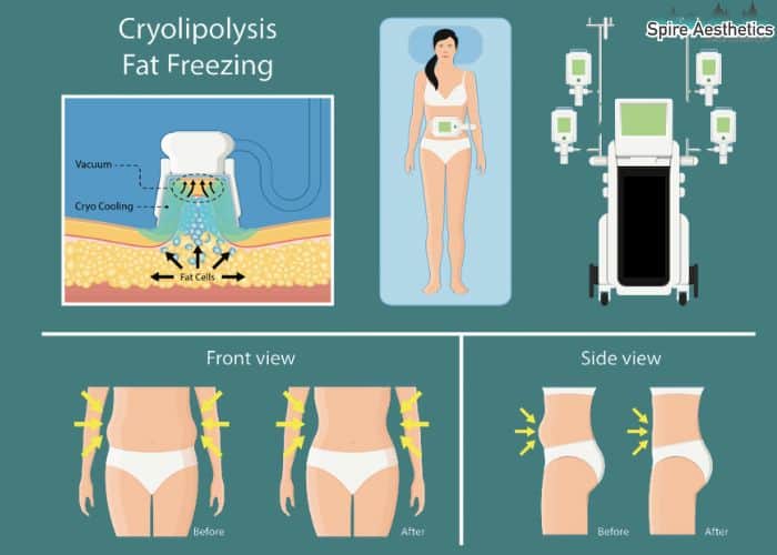Image of diet and fat freezing combined for best results for Spire Aesthetics Margate