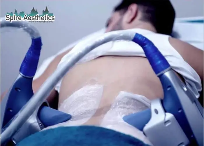 Man having fat freezing treatment done on love handles before a competitions Margate to create a sculpted look.