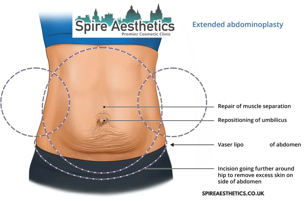 Understanding Loose Skin After Gastric Band Margate Surgery and HIFU Treatment