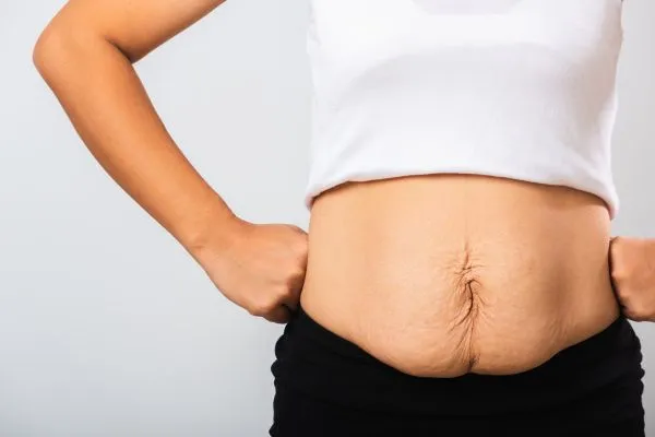 Image of a woman's stomach after weight loss with sagging skin following a gastric band Margate