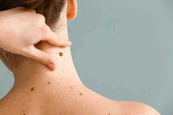 skin blemish removal Margate treatment