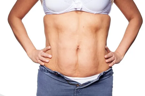 sagging skin on woman's stomach after weight loss injections Margate