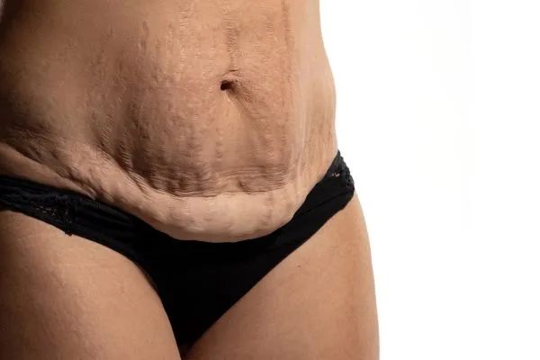 Image of womans stomach after weight loss injections Margate showing saggy skin