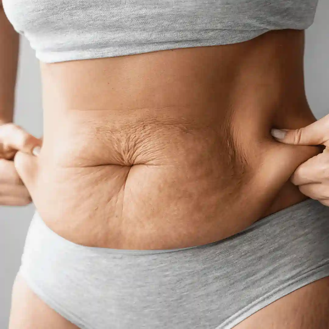 Is It Normal to Have Loose Skin After Pregnancy Margate?