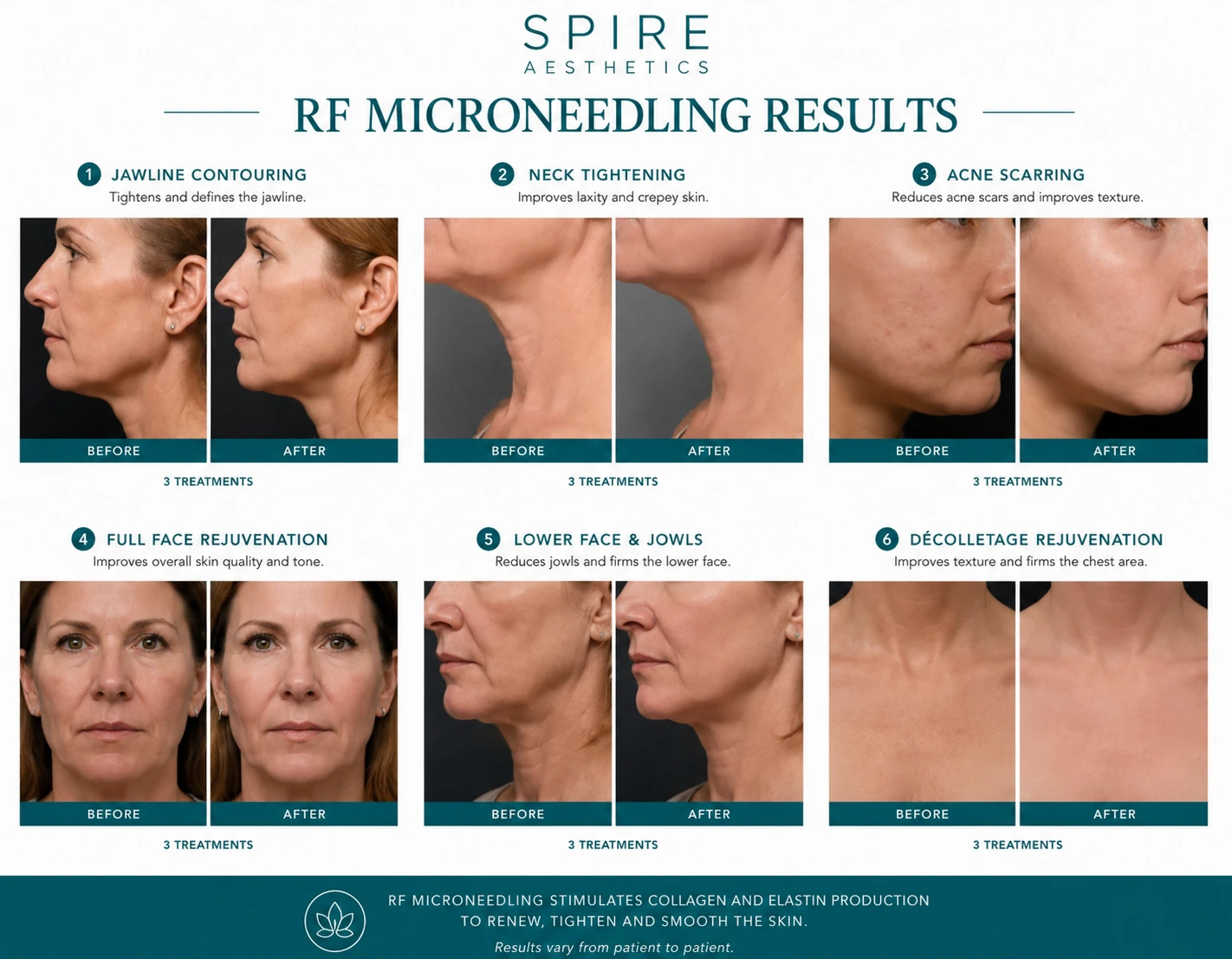 RF Microneedling Skin tightening Margate results
