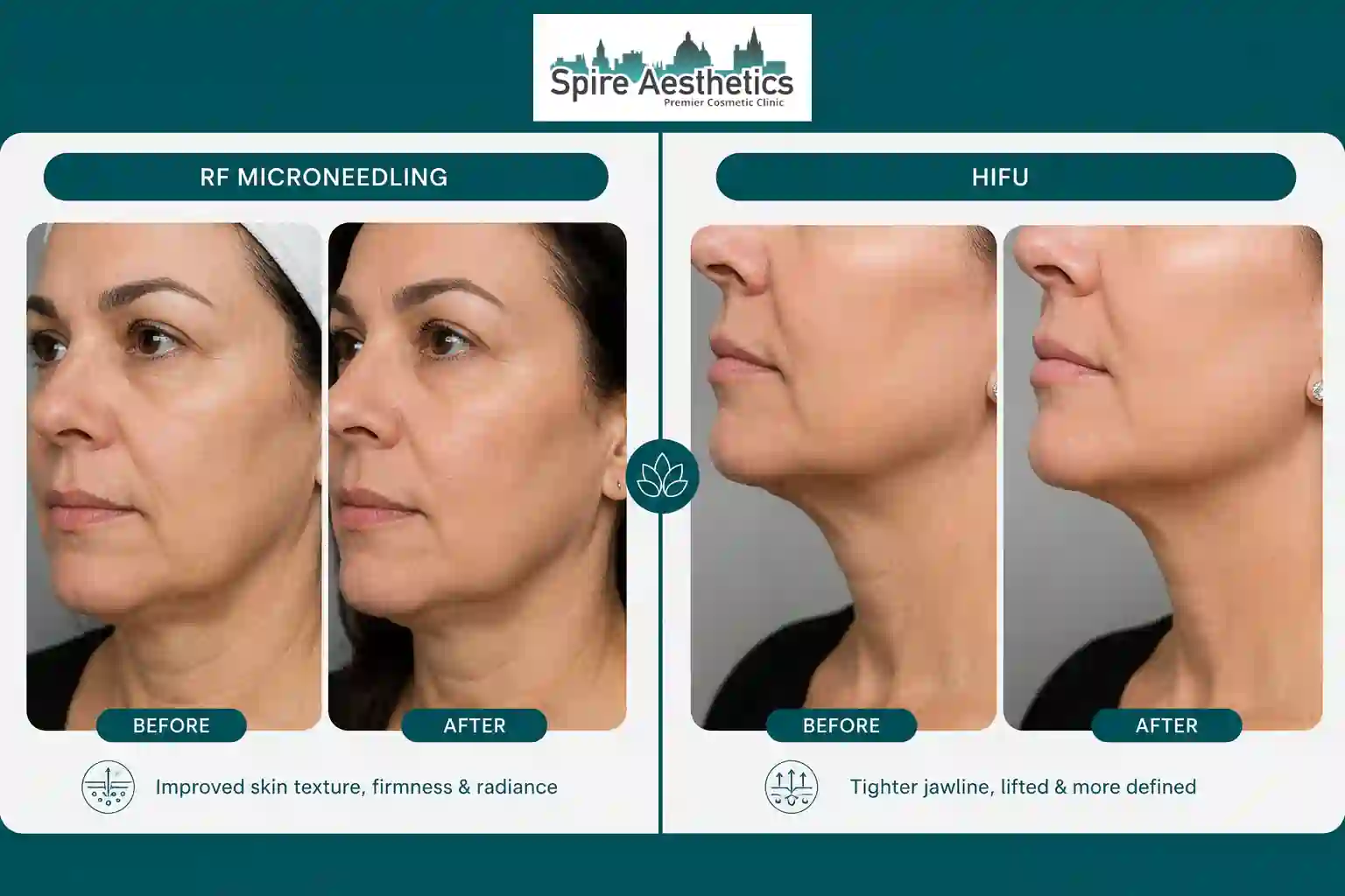 Can RF Microneedling and HIFU Be Combined Margate?