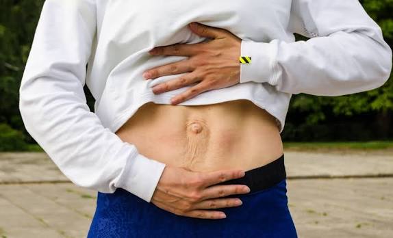 When Could Diastasis Recti Be the Missing Piece of the Puzzle Margate?